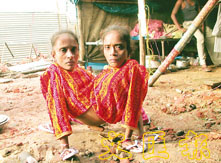 印度<em>连体姊妹</em>不敢分离 - 香港文汇报