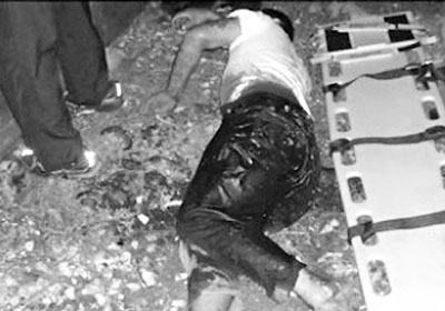 入珠男阴囊中弹+「不明物体」吓坏医生