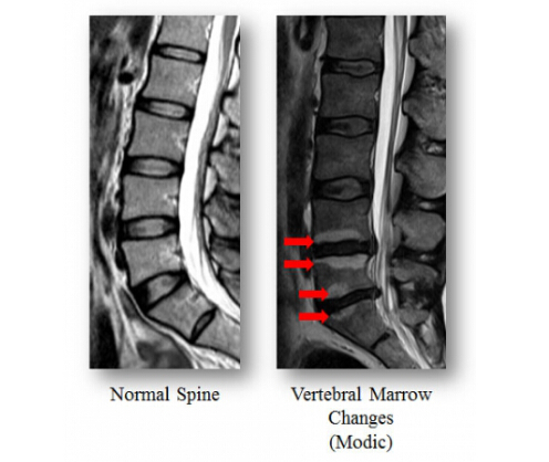 圖左：顯示沒有Modic異變的正常脊骨；圖右：紅色箭頭顯示出現Modic異變的脊椎椎骨體變化，透過異變範圍和受影響的椎體數量，可得知病人腰痛的成因和嚴重程度。
