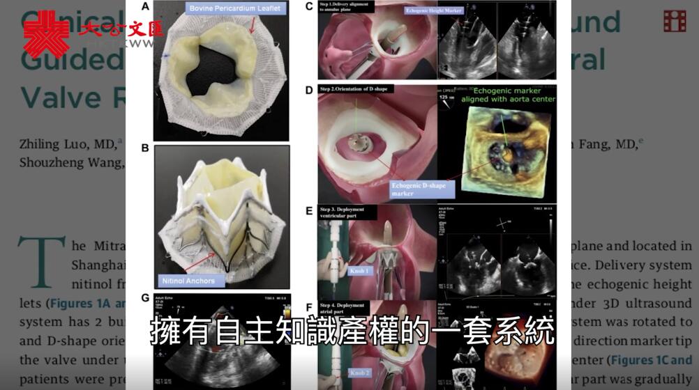 國際專業期刊�mJACC�n刊文 中國原創全球首例�u二尖瓣置換術�v成功 